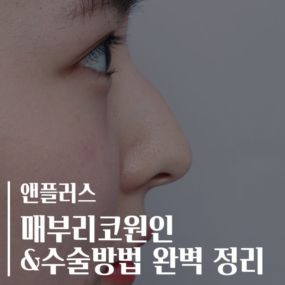 A Complete Guide to the Causes of a Hump Nose and Surgical Methods image 1