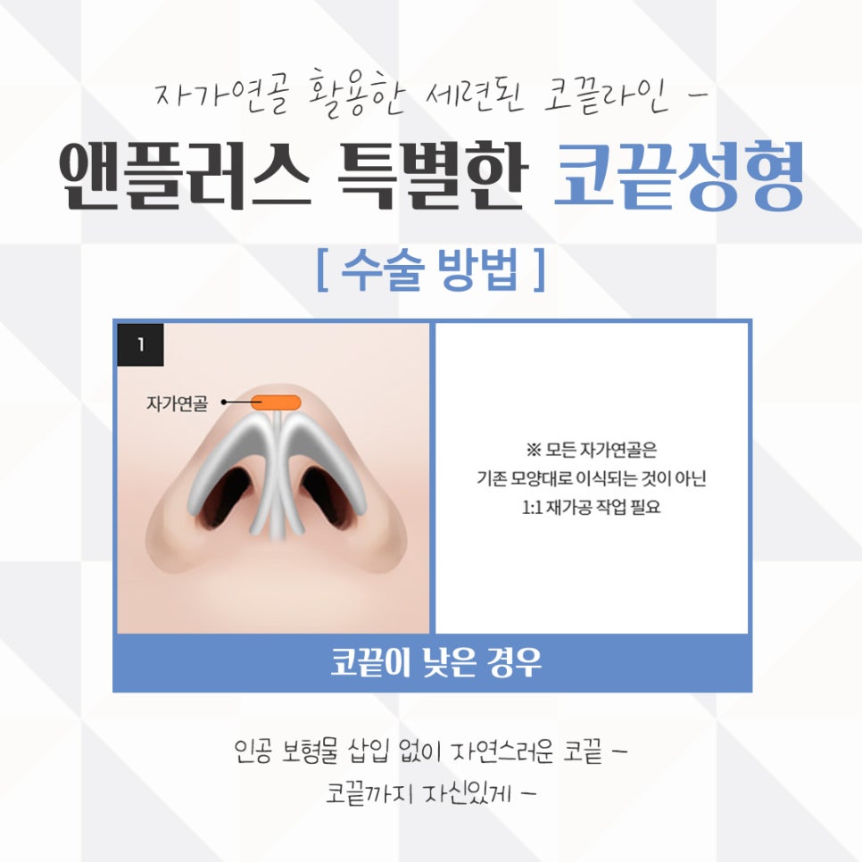 Nose Tip Surgery Review: Natural Results with Nose Tip Cartilage Stitching image 9