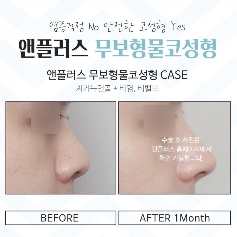 무보형물코성형후기 자연스러운 이미지로 관련 이미지 12