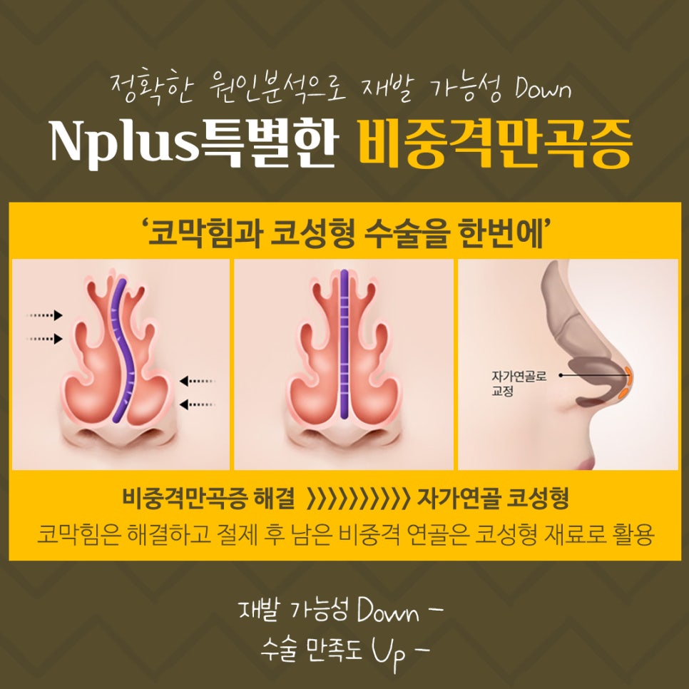 Septoplasty Methods and Causes image 9