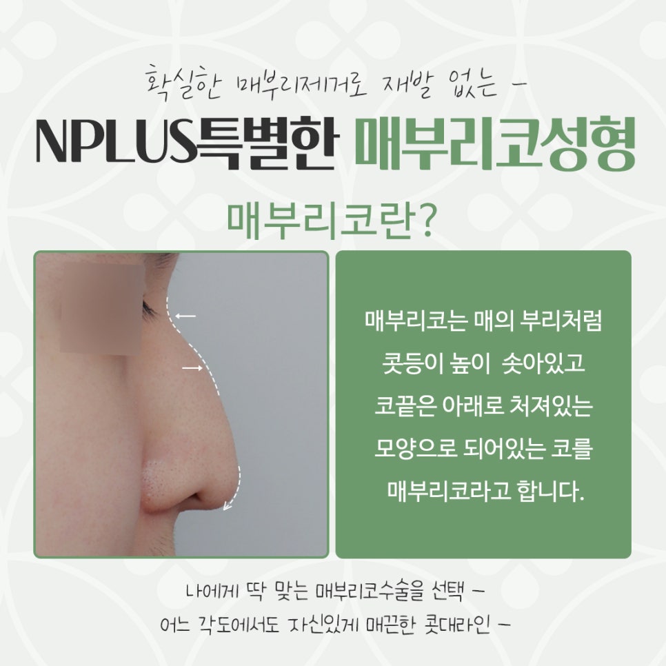Hump Nose Surgery Review: Check Carefully image 3