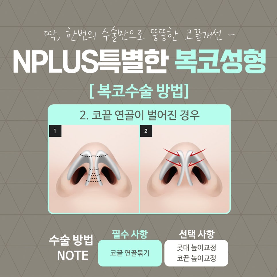 복코수술후기를  확인하고 세련된 이미지로 관련 이미지 10