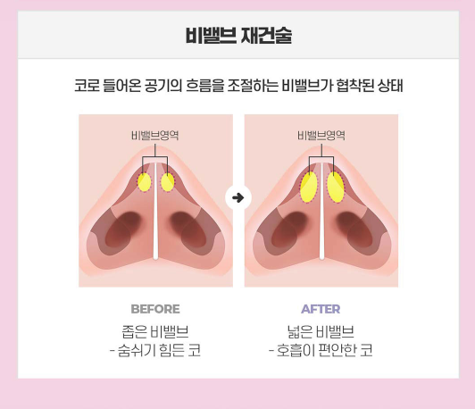 Learn More About Functional Rhinoplasty Events in Detail image 11
