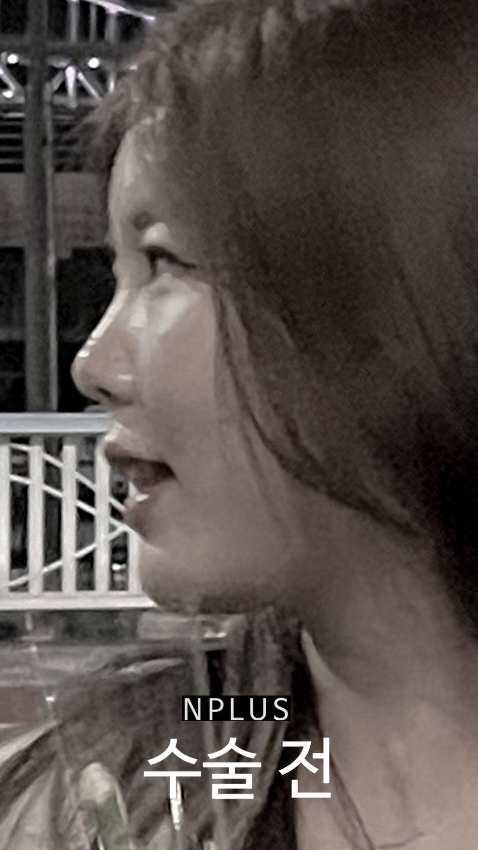 Short and Upturned Nose Shape Corrected with Autologous Rib Cartilage Nose Surgery at N Plus Clinic! image 1