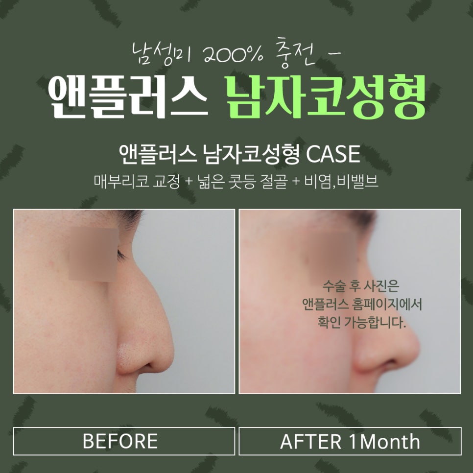 남자코성형 직선코라인으로 기능까지 확인하여 관련 이미지 14