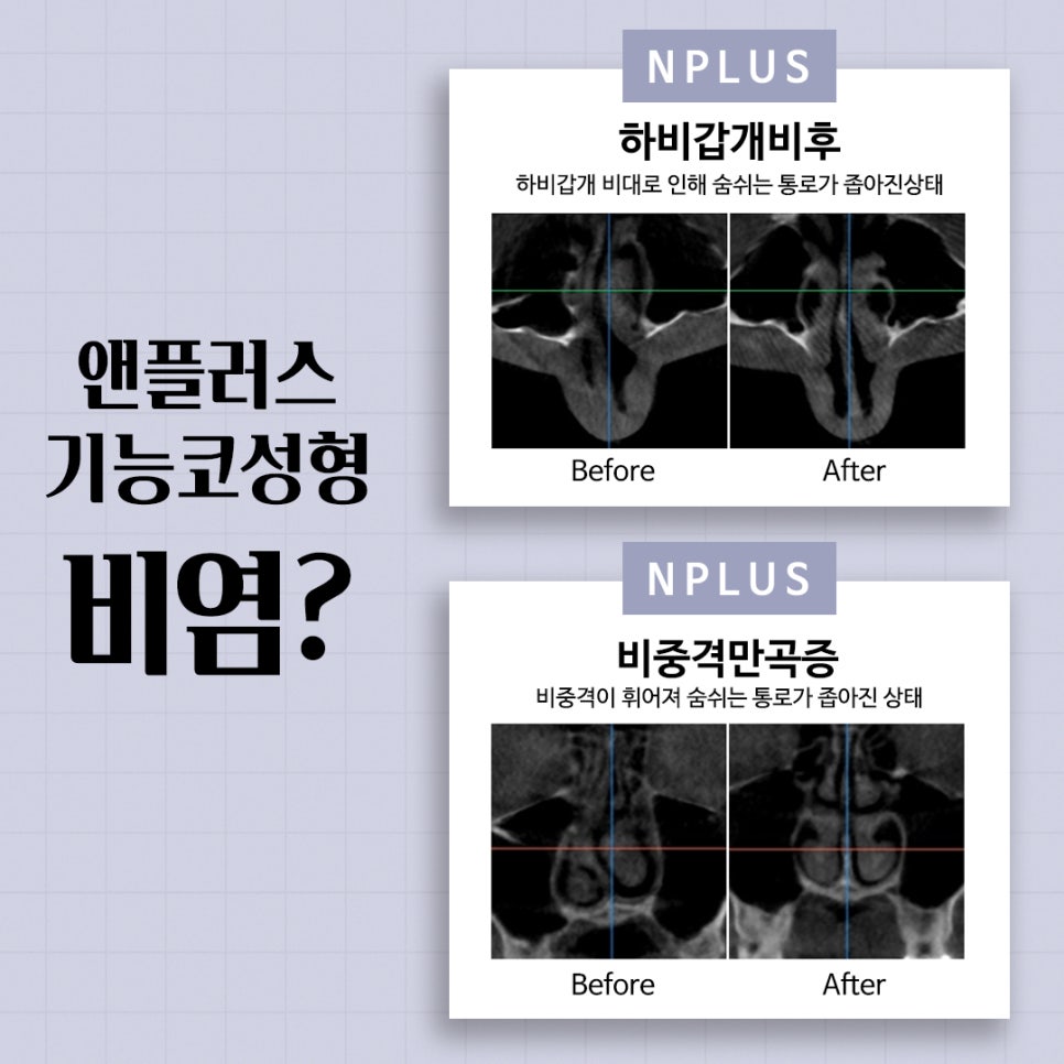 Learn More About Functional Nose Surgery Medical Expense Coverage image 4