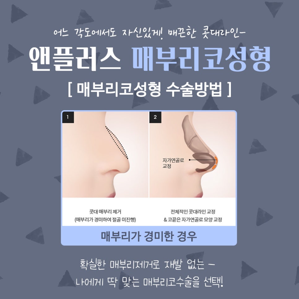 남자매부리코성형 기능까지 고려해서 관련 이미지 9