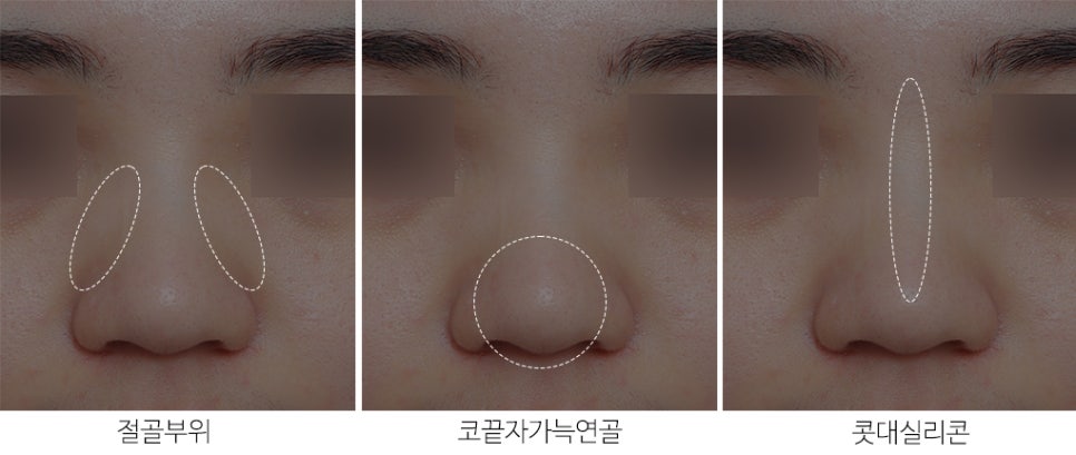 복코수술후기_뭉툭한 코라인을 자연스럽게 관련 이미지 3