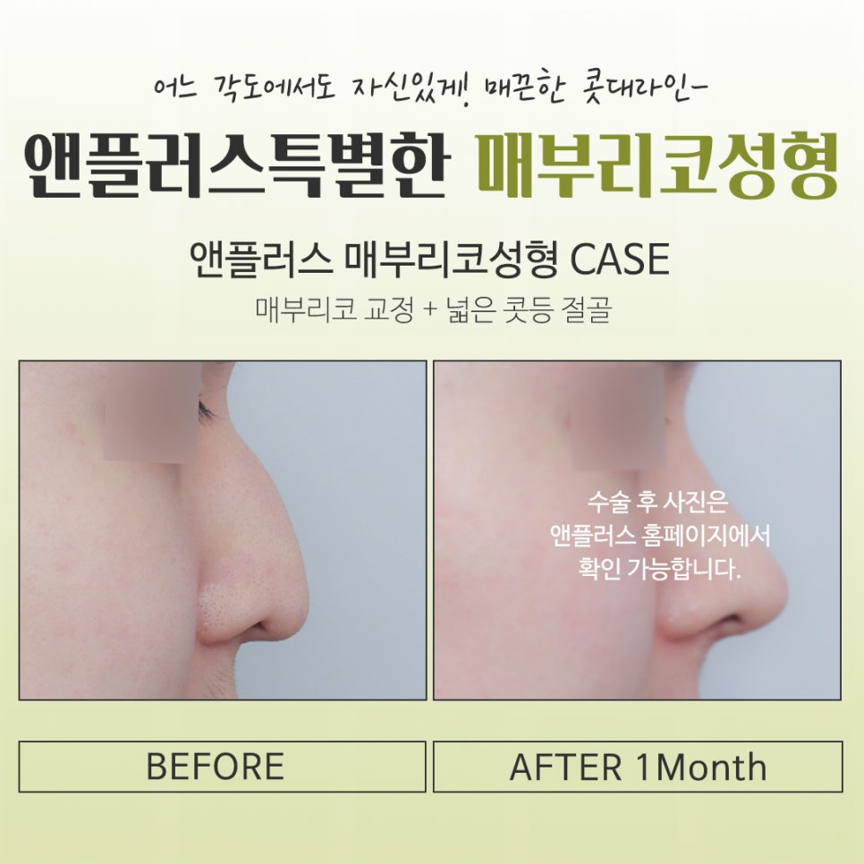 매부리코수술후기 다양한 이미지를 확인하고 관련 이미지 15