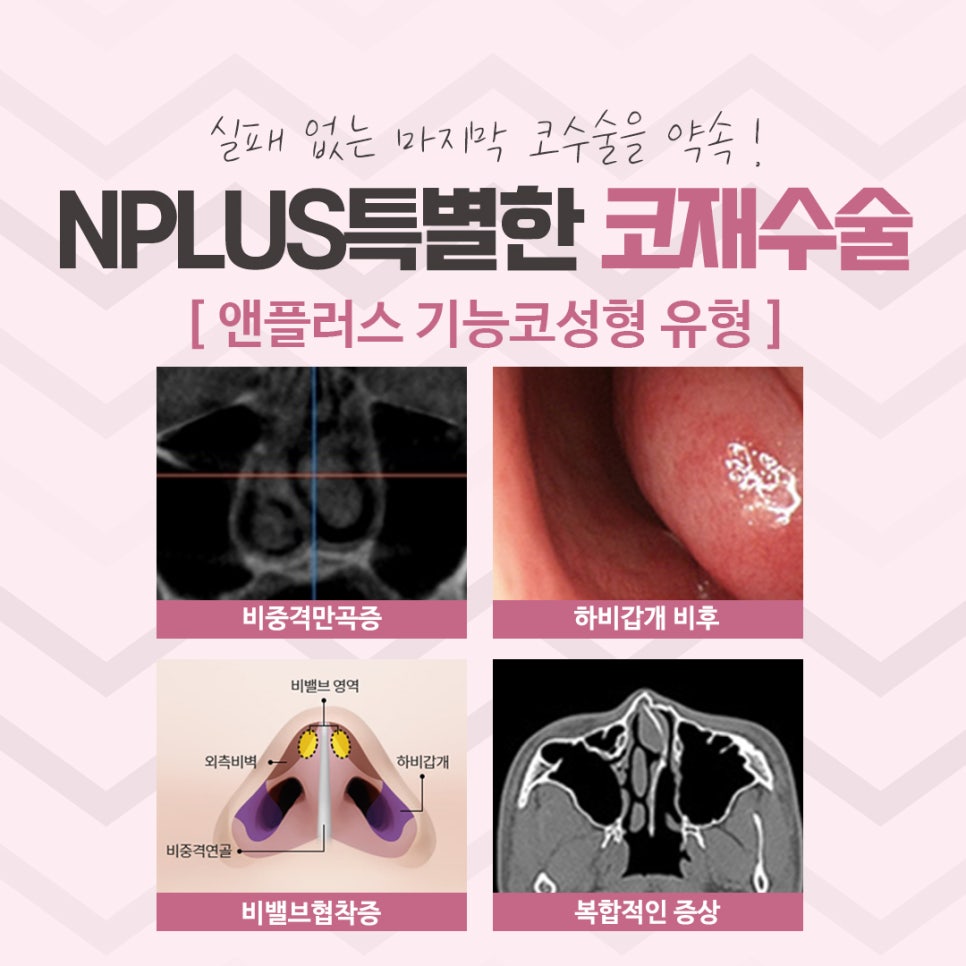 Review of Revision Rhinoplasty: Exploring Various Aspects image 7
