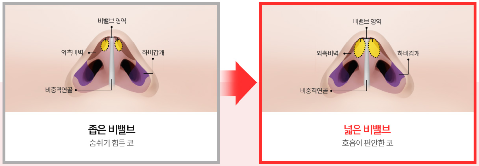 비염의 원인과 해결 방법! 관련 이미지 19