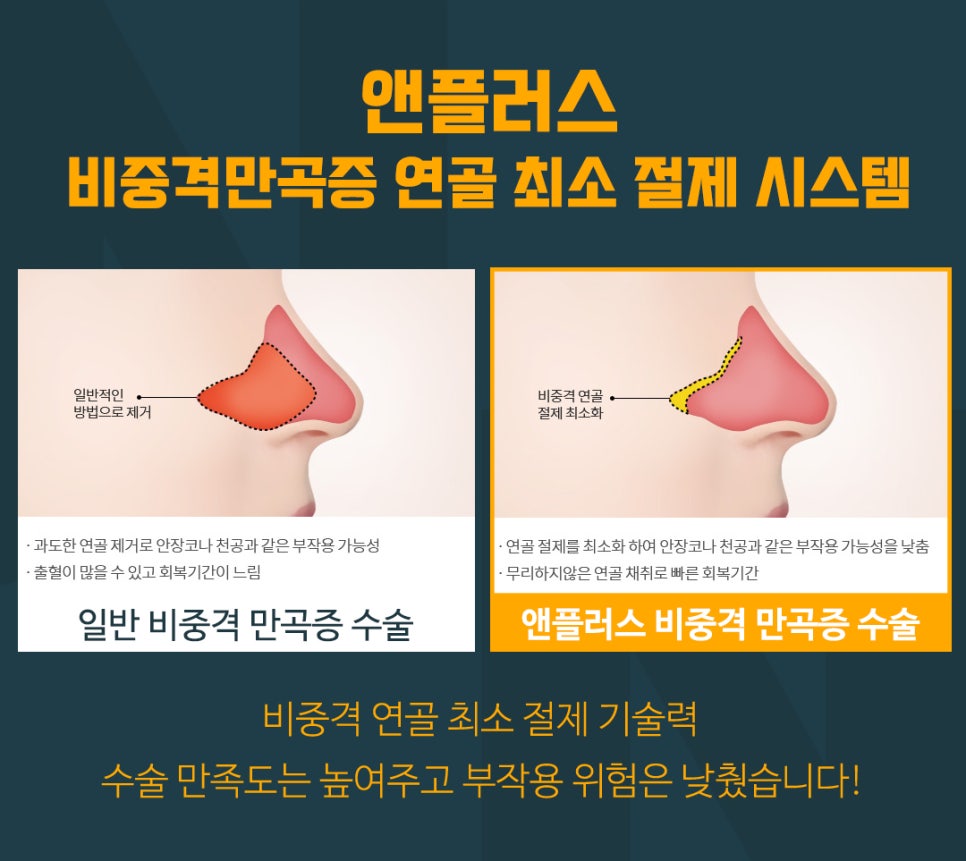 코성형,첫 수술부터 갈비뼈(자가늑연골)로 이식해야 하는 이유 관련 이미지 4