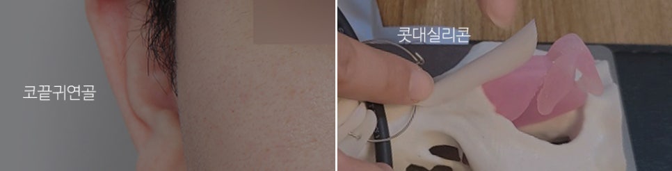 남자 복코와 매부리코 수술 후기 관련 이미지 4