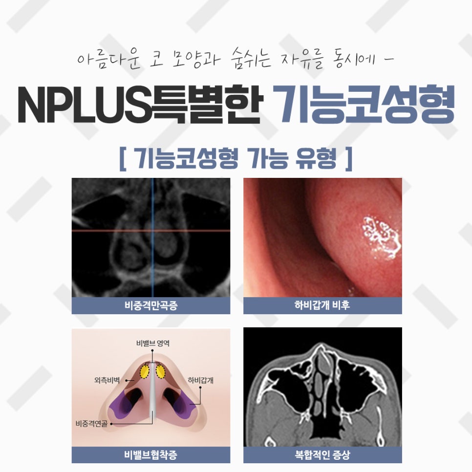 비염코성형실비 꼼꼼하게 체크하고 관련 이미지 11