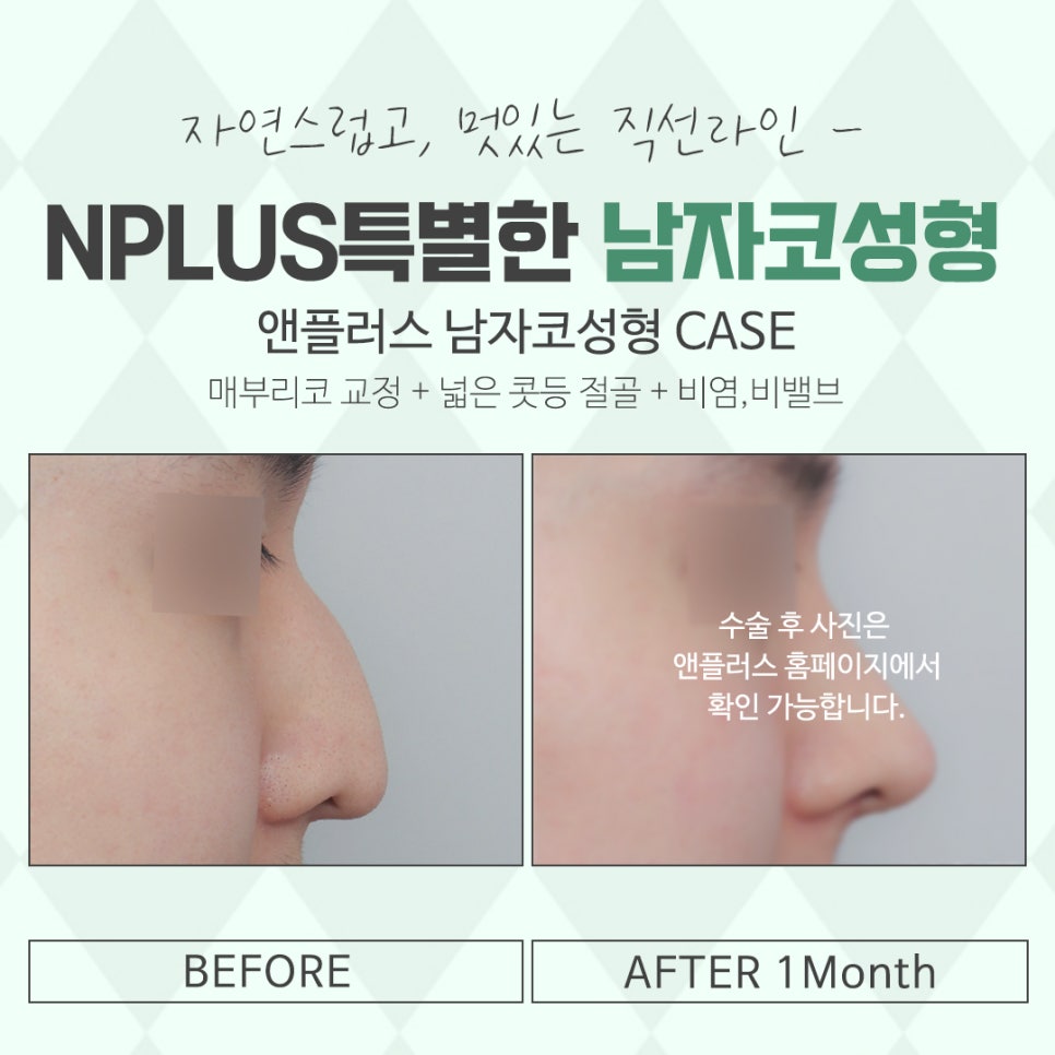 남자성형 잘 판단하고 결정 관련 이미지 14