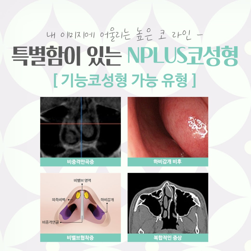 코성형잘하는곳에 대해 비교해 보고 관련 이미지 6