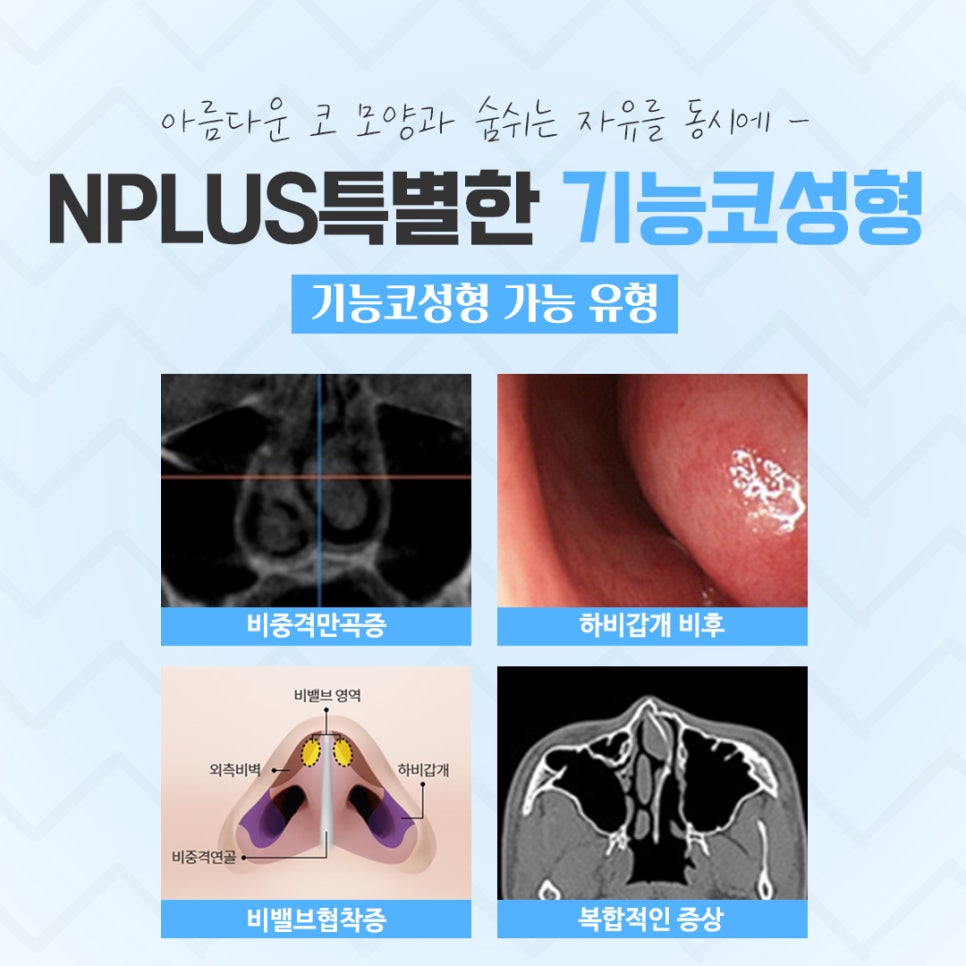 기능코성형후기를 신중하게 알아보고 관련 이미지 5