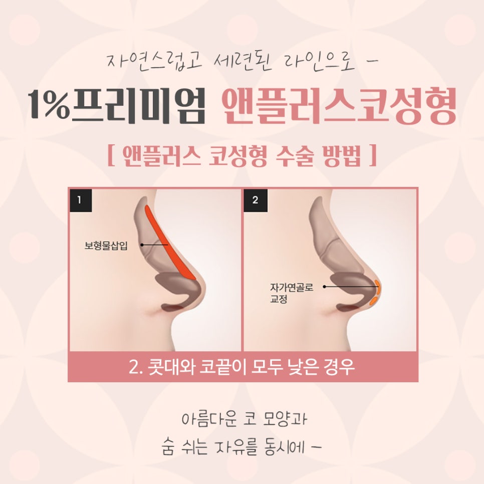 자가늑연골코성형을 통한 이미지 개선 관련 이미지 9
