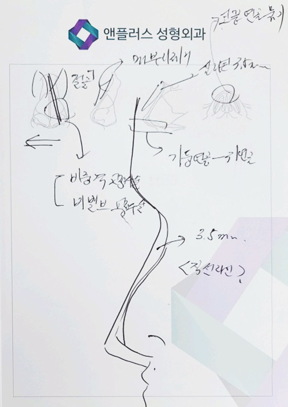 남자매부리코_비염수술과 동시에 관련 이미지 6