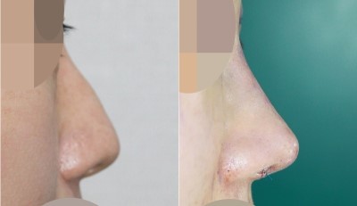 휜코수술가격 안내 및 앤플러스 전후사진 관련 이미지 1