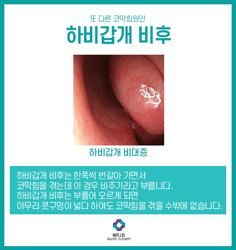 For Septoplasty Surgery, Experience Matters at the Hospital image 6