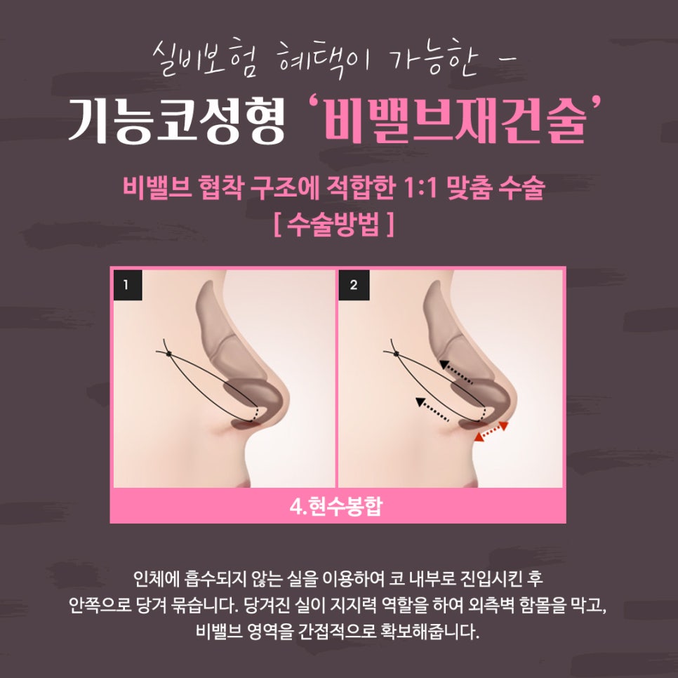 비밸브재건술 확실한 강남앤플러스에서 관련 이미지 13