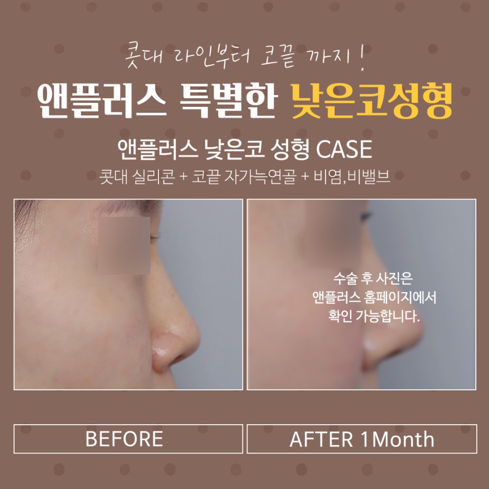 낮은코성형후기 세련된 이미지로 관련 이미지 13