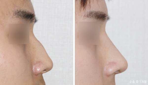 남자코성형전후 수술적 경험 후기 관련 이미지 3