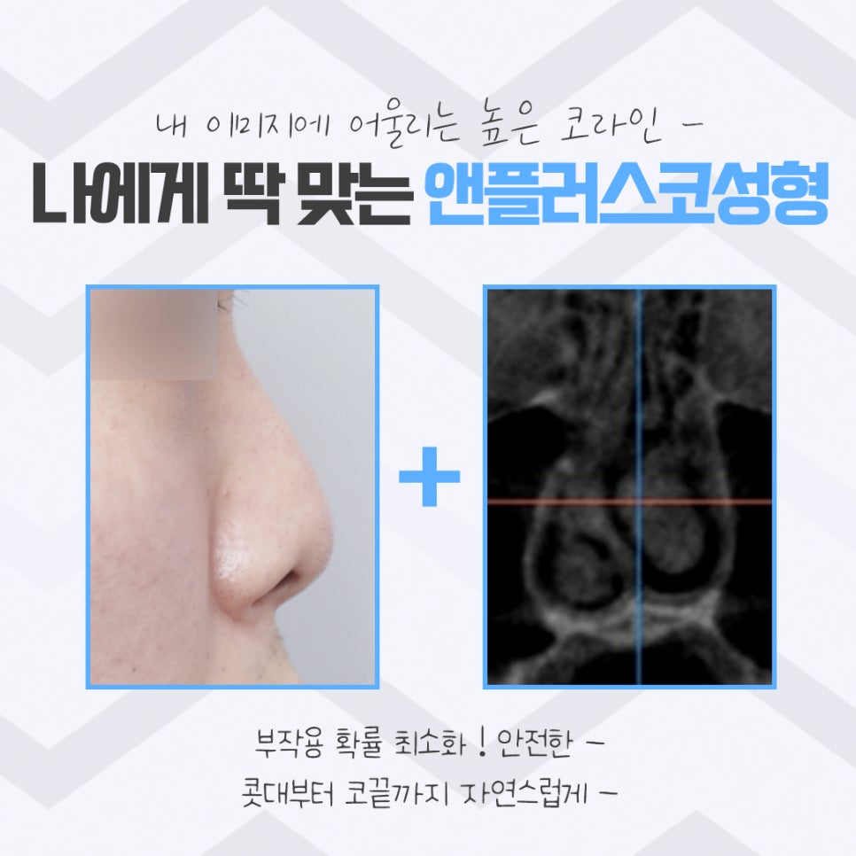 코성형후기를 다양하게 찾아보고 관련 이미지 4