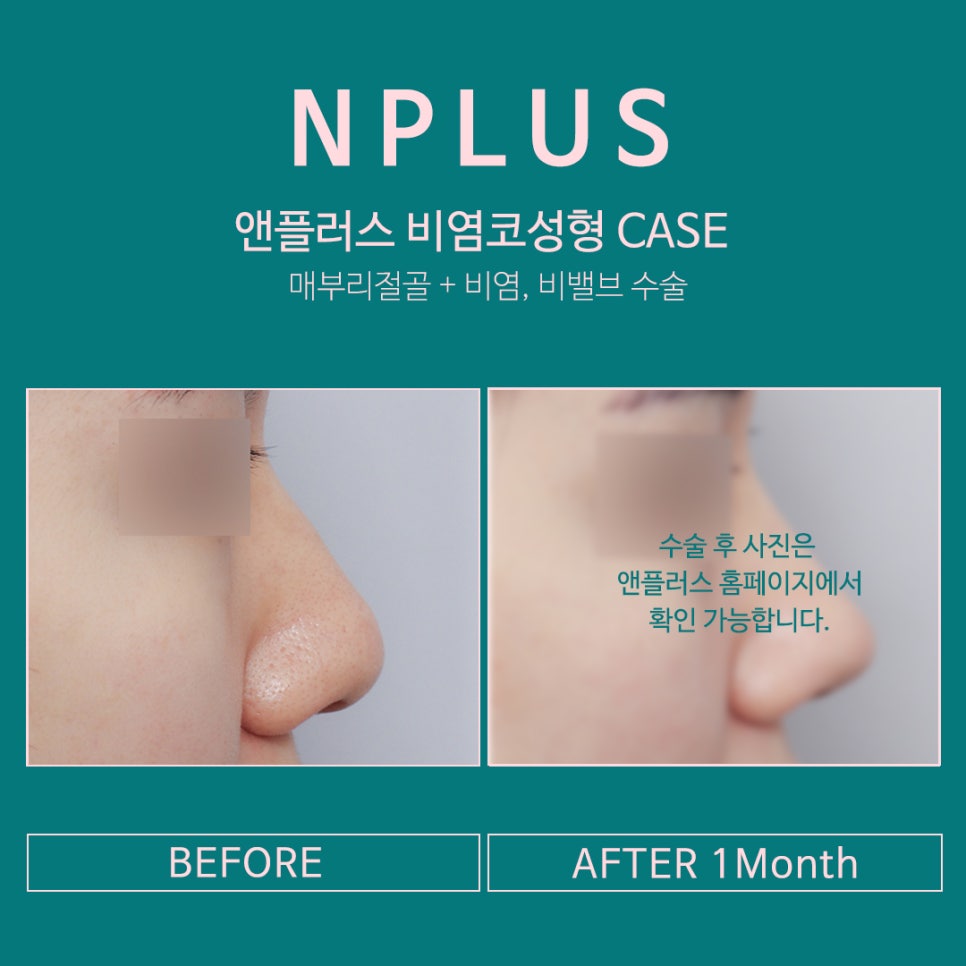 비염실비 꼼꼼하게 알아보고 체크하자 관련 이미지 10