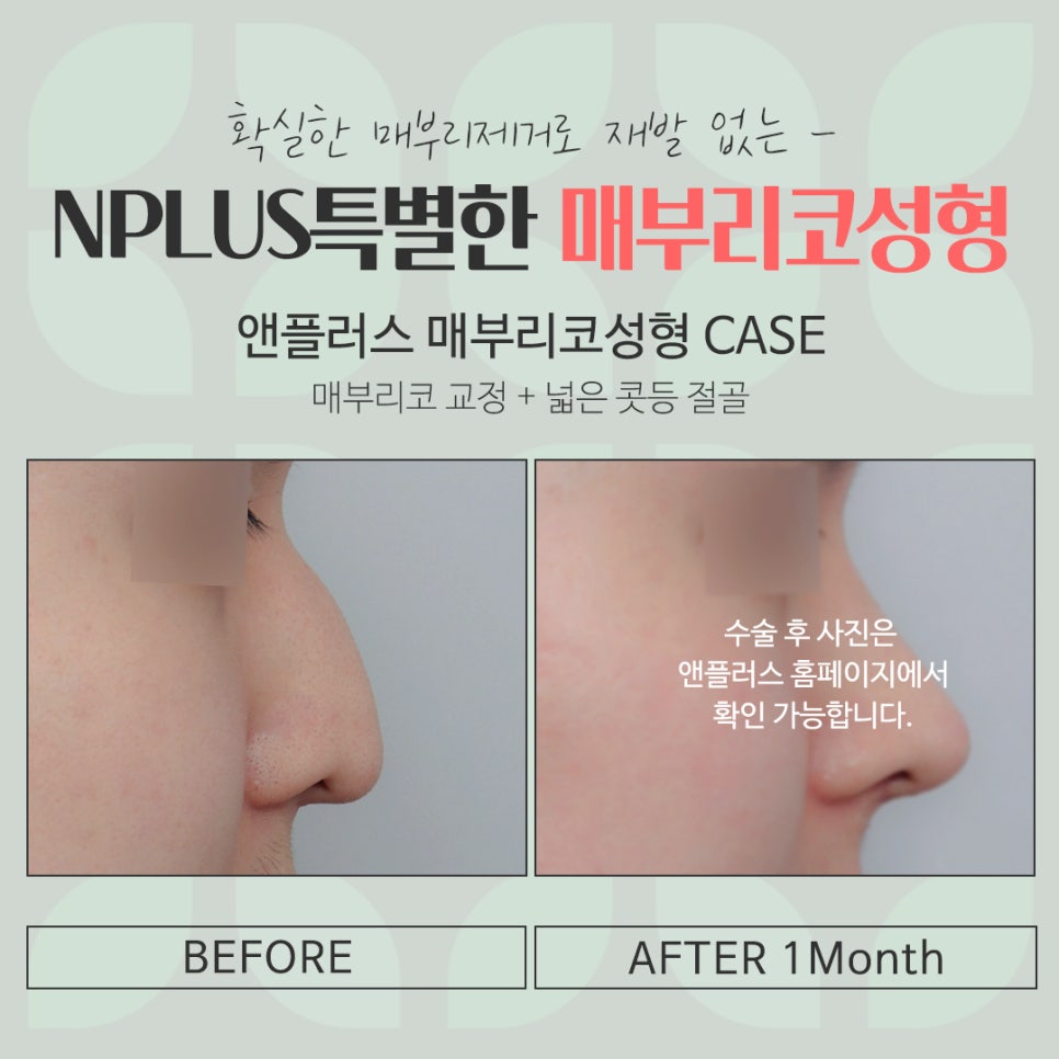 매부리코교정으로 부드러운 인상 관련 이미지 16