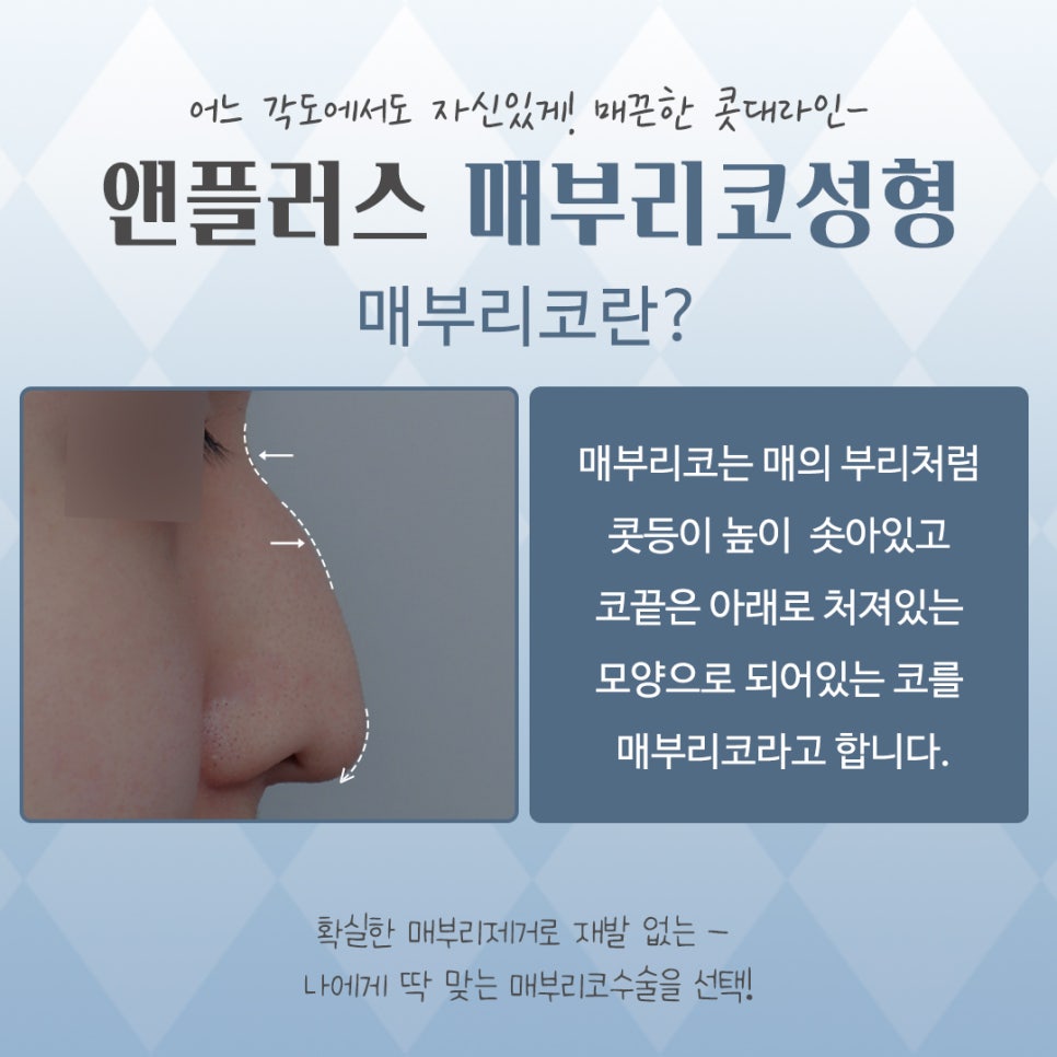 Looking into Cases of Before and After Hump Nose Surgery image 3