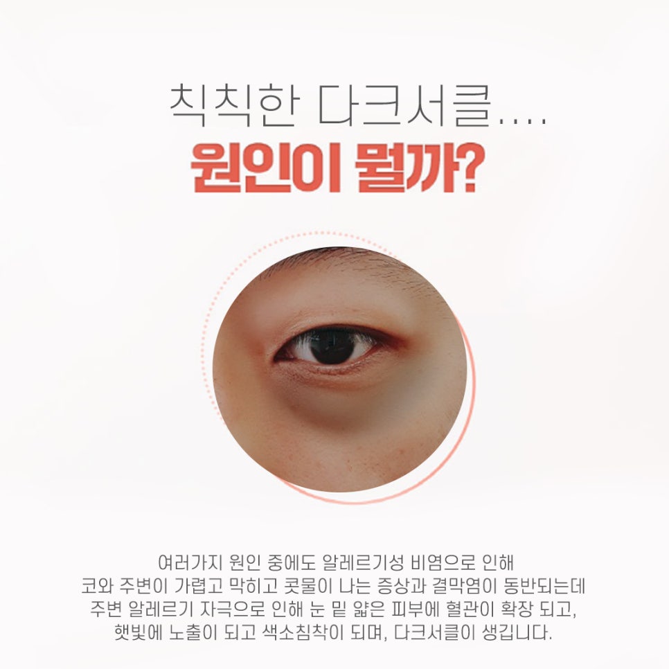 다크서클과 비염! 관계가 있을까요? 관련 이미지 2