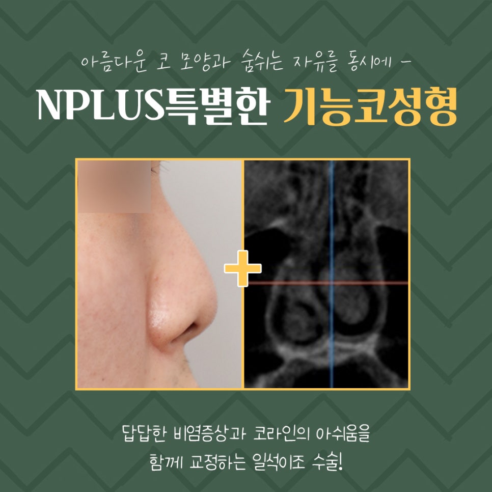 기능코성형후기 꼼꼼하게 알아보고 관련 이미지 4
