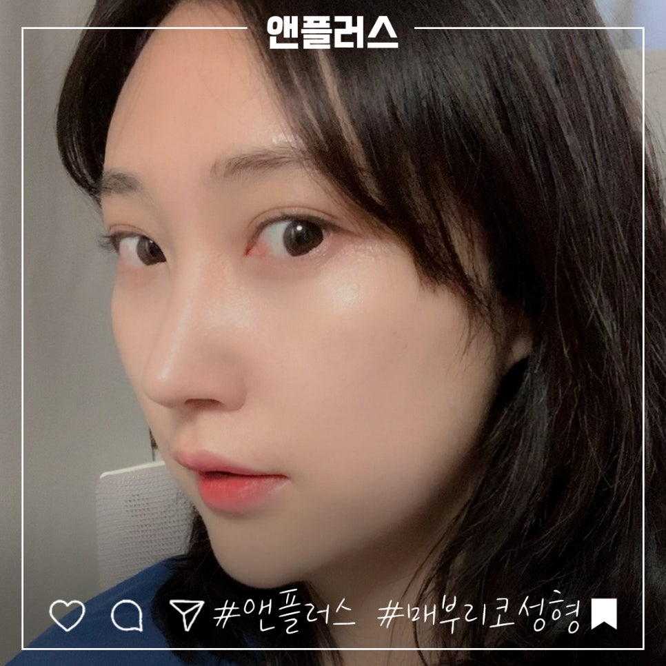 매부리코성형후기 꼼꼼하게 알아보고 관련 이미지 9