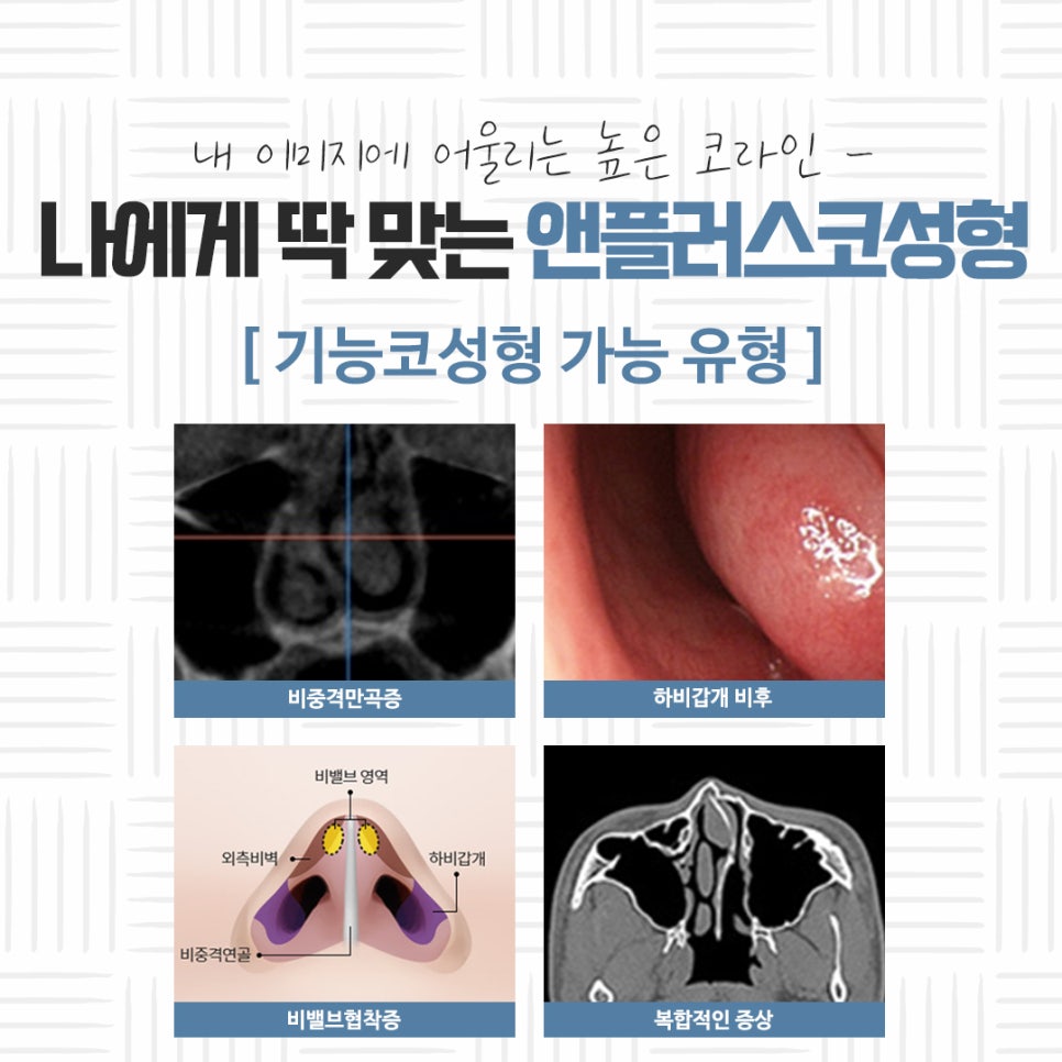 자가연골 이용한 코성형 후기 관련 이미지 11