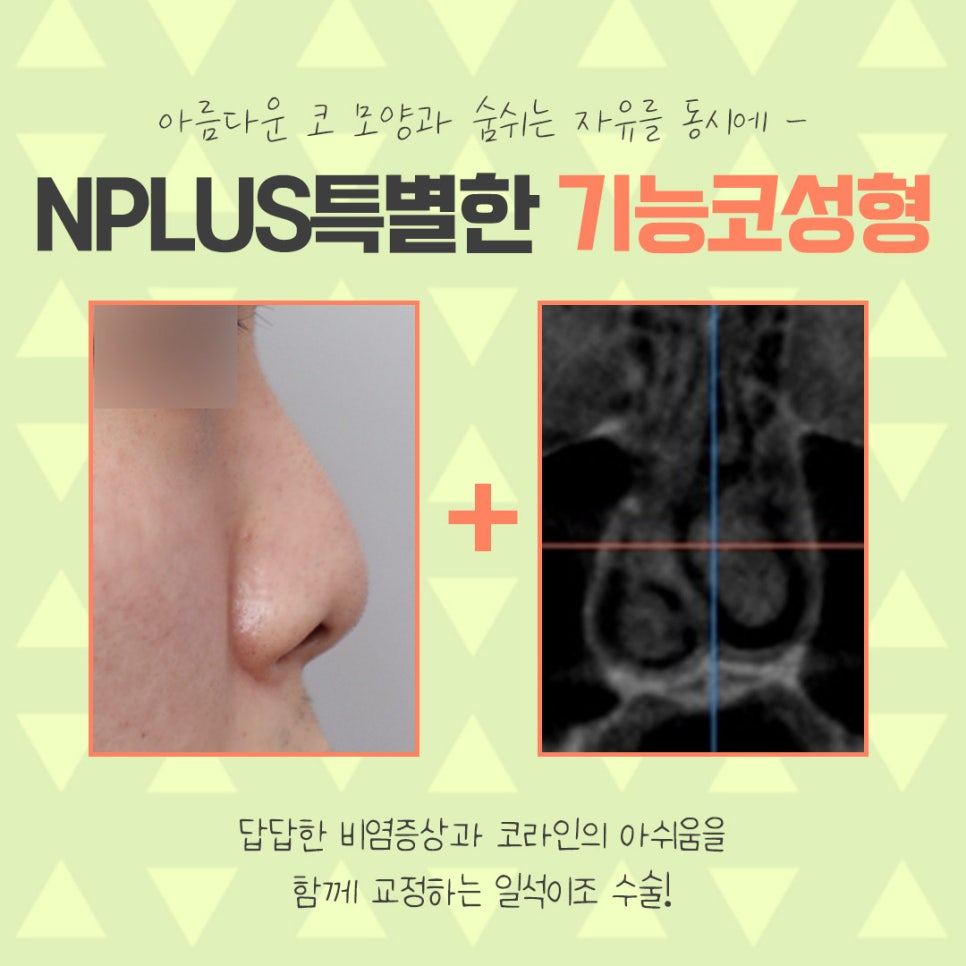코성형보험에 대해 정확하게 알아보고 관련 이미지 6