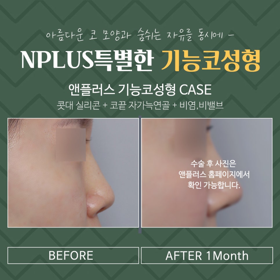 기능코성형후기 꼼꼼하게 알아보고 관련 이미지 7