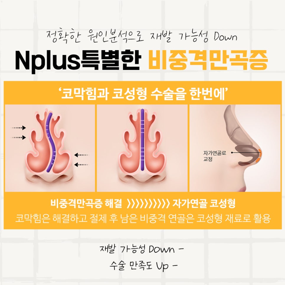 Septoplasty Surgery Review: With a Careful Decision image 10