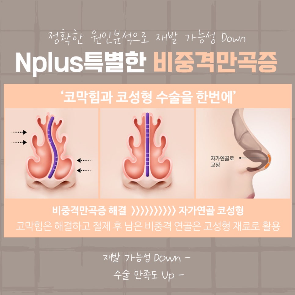 비중격만곡증수술후기 신중하게 고려하여 관련 이미지 10