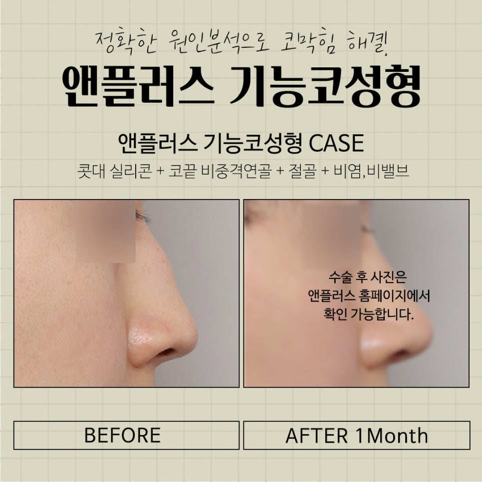 Carefully Learn About Functional Nose Surgery Coverage and Nose Reshaping image 12