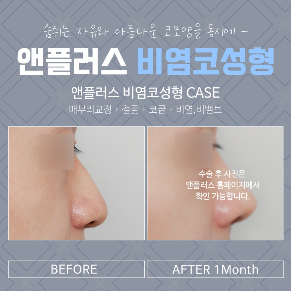 Nasal Correction Rhinoplasty Review: Identifying the Cause Properly image 14