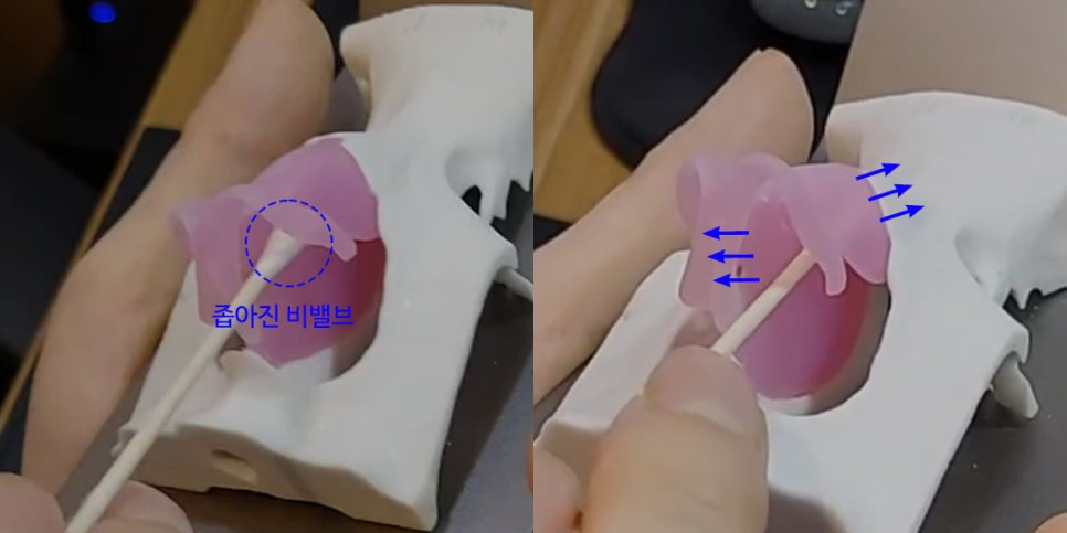 비염코성형에 대한 모든 것 완벽 정리 관련 이미지 6