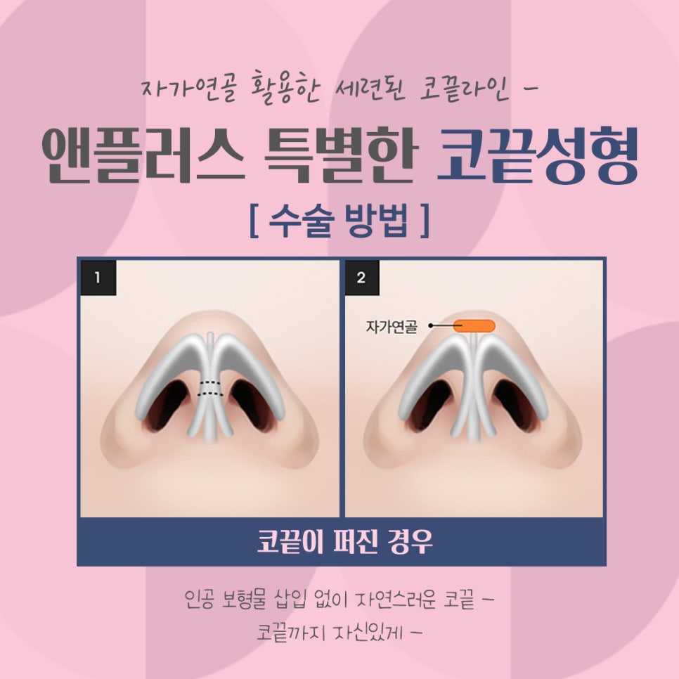 코끝처짐 개선한 코끝성형후기 관련 이미지 10