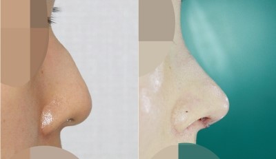 남자코성형 앤플러스성형외과 수술전&후 사진비교 관련 이미지 1