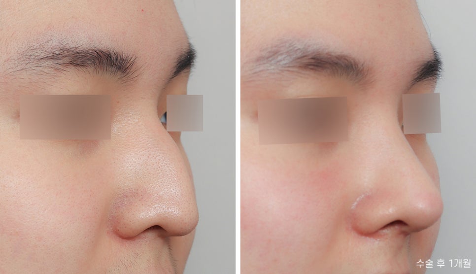 Hooked Nose Before-and-After Photos for a Softer Look image 4