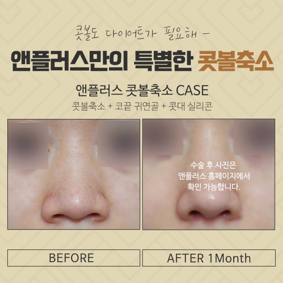 Nasal Ala Reduction Review: Research Carefully Before Deciding image 5