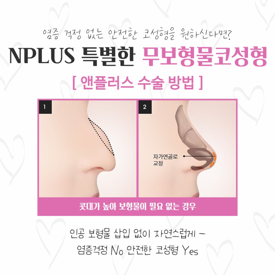 Checking Whether Non-Implant Nose Surgery Is Possible image 7
