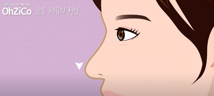 코성형 후 코끝처짐 원인과 해결 방법 관련 이미지 8
