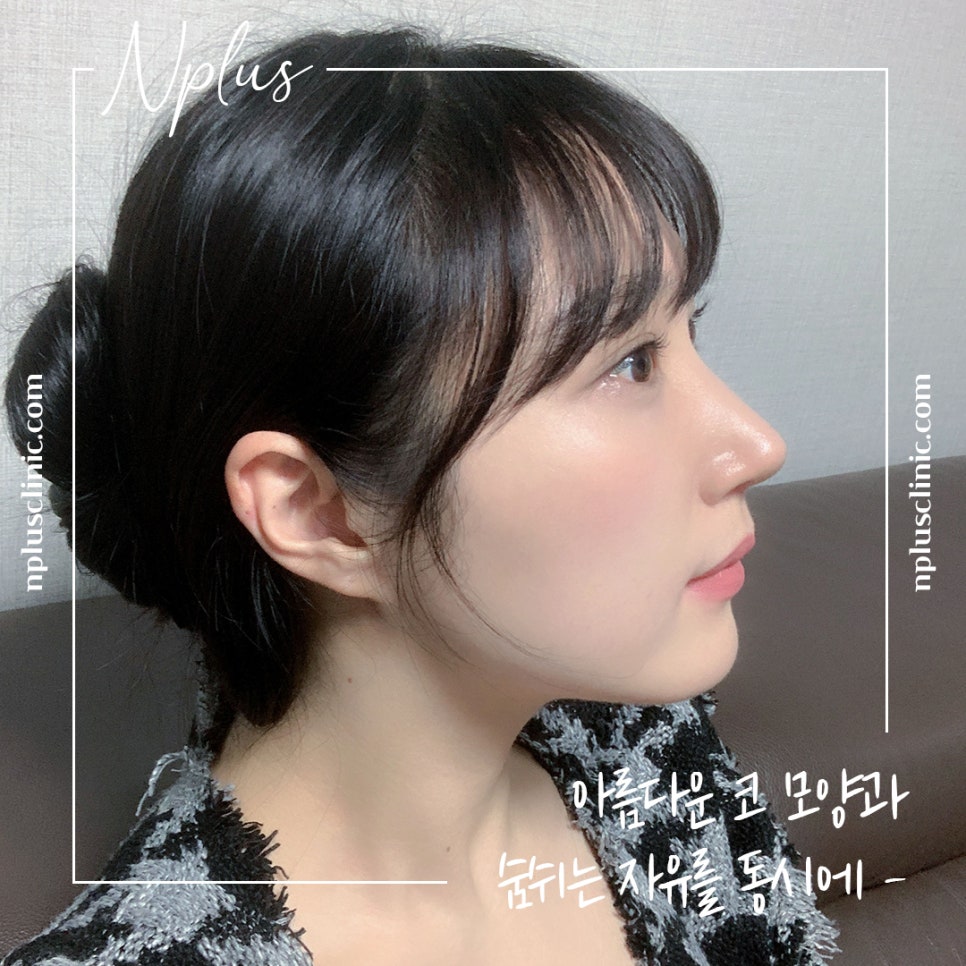 Reviewing Nostril Reduction Results and Improving Your Appearance image 3